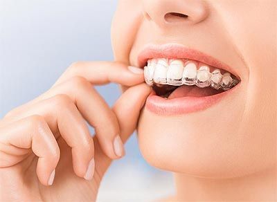 Invisalign para adultos